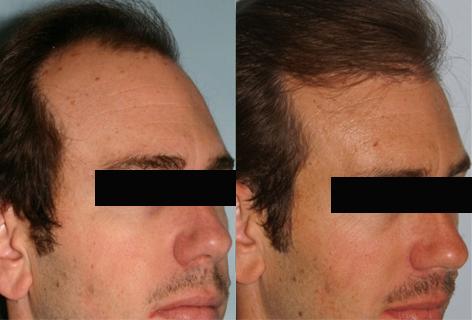 Follicular Unit Hair Grafting before and after photos in San Francisco, CA, Patient 13580