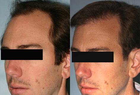 Follicular Unit Hair Grafting before and after photos in San Francisco, CA, Patient 13580