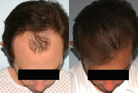 Follicular Unit Hair Grafting before and after photos in San Francisco, CA, Patient 13580