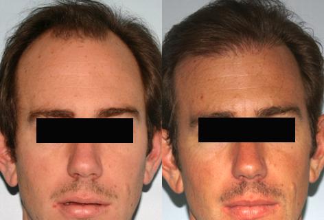 Follicular Unit Hair Grafting before and after photos in San Francisco, CA, Patient 13580