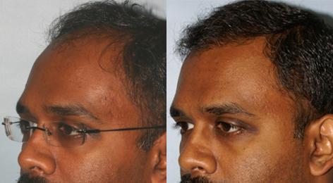 Follicular Unit Hair Grafting before and after photos in San Francisco, CA, Patient 13589