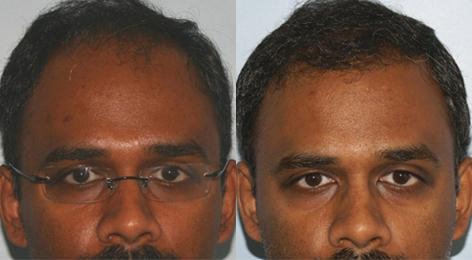 Follicular Unit Hair Grafting before and after photos in San Francisco, CA, Patient 13589