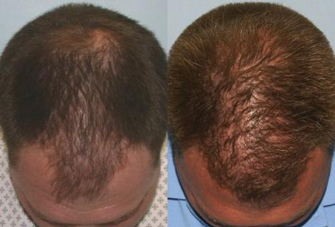 Follicular Unit Hair Grafting before and after photos in San Francisco, CA, Patient 13594