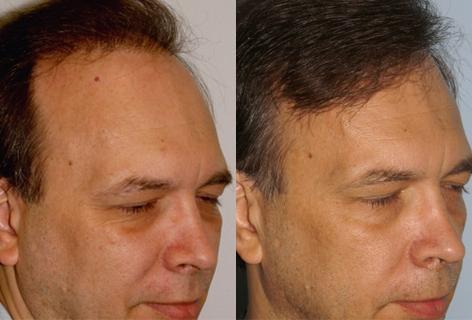 Follicular Unit Hair Grafting before and after photos in San Francisco, CA, Patient 13599