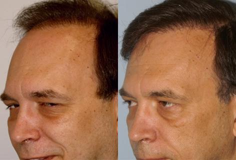 Follicular Unit Hair Grafting before and after photos in San Francisco, CA, Patient 13599