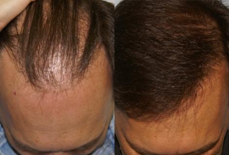Follicular Unit Hair Grafting before and after photos in San Francisco, CA, Patient 13599