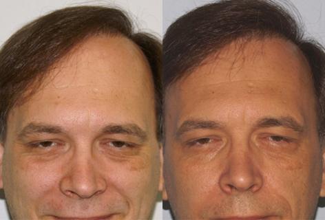 Follicular Unit Hair Grafting before and after photos in San Francisco, CA, Patient 13599