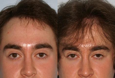 Follicular Unit Hair Grafting before and after photos in San Francisco, CA, Patient 13626