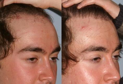 Follicular Unit Hair Grafting before and after photos in San Francisco, CA, Patient 13626