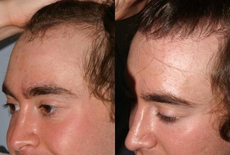 Follicular Unit Hair Grafting before and after photos in San Francisco, CA, Patient 13626