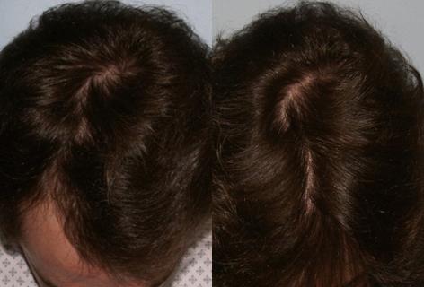 Patient 13626, Follicular Unit Hair Grafting before and after photos Follicular Unit Hair Grafting before and after photos in San Francisco, CA, Patient 13626