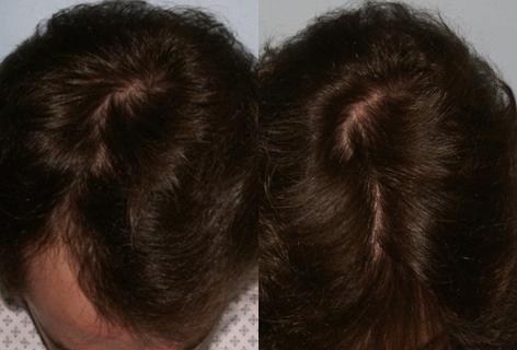 Follicular Unit Hair Grafting before and after photos in San Francisco, CA, Patient 13626