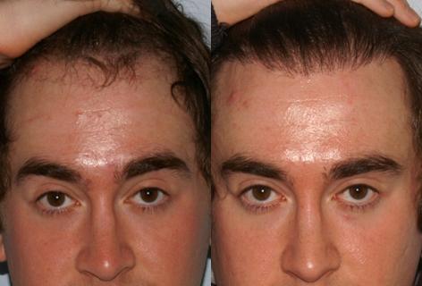 Follicular Unit Hair Grafting before and after photos in San Francisco, CA, Patient 13626