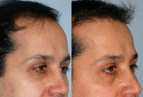 Follicular Unit Hair Grafting before and after photos in San Francisco, CA, Patient 13637