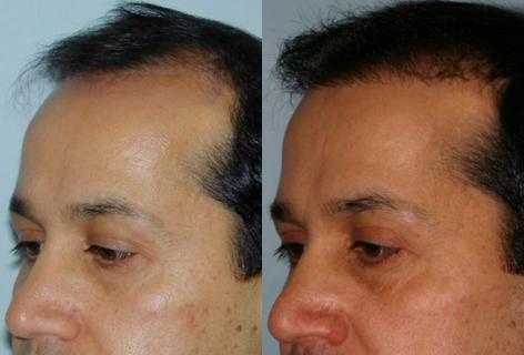 Follicular Unit Hair Grafting before and after photos in San Francisco, CA, Patient 13637