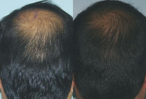 Follicular Unit Hair Grafting before and after photos in San Francisco, CA, Patient 13637