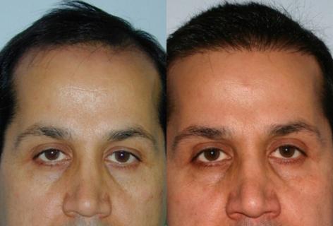 Follicular Unit Hair Grafting before and after photos in San Francisco, CA, Patient 13637