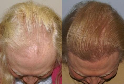 Follicular Unit Hair Grafting before and after photos in San Francisco, CA, Patient 13652