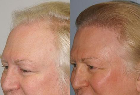 Follicular Unit Hair Grafting before and after photos in San Francisco, CA, Patient 13652