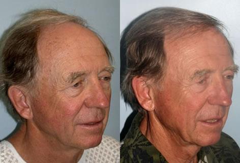 Follicular Unit Hair Grafting before and after photos in San Francisco, CA, Patient 13657