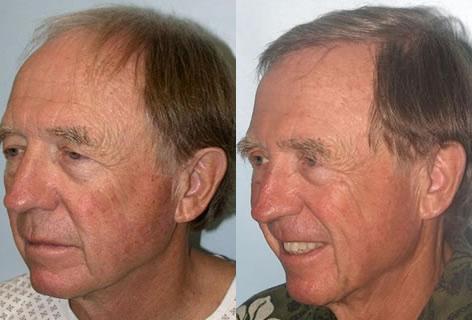 Follicular Unit Hair Grafting before and after photos in San Francisco, CA, Patient 13657