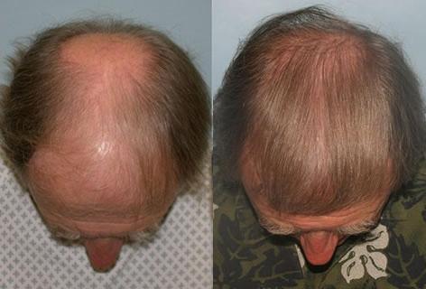 Follicular Unit Hair Grafting before and after photos in San Francisco, CA, Patient 13657