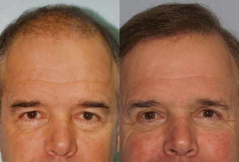 Follicular Unit Hair Grafting before and after photos in San Francisco, CA, Patient 13666