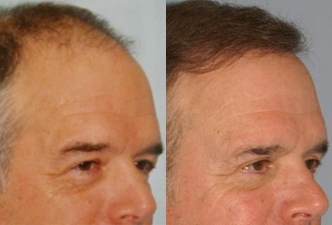 Patient 13666, Follicular Unit Hair Grafting before and after photos Follicular Unit Hair Grafting before and after photos in San Francisco, CA, Patient 13666