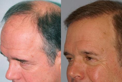 Follicular Unit Hair Grafting before and after photos in San Francisco, CA, Patient 13666