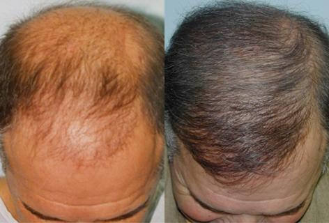 Follicular Unit Hair Grafting before and after photos in San Francisco, CA, Patient 13666