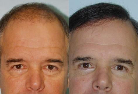 Patient 13666, Follicular Unit Hair Grafting before and after photos Follicular Unit Hair Grafting before and after photos in San Francisco, CA, Patient 13666