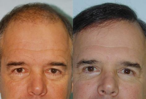 Follicular Unit Hair Grafting before and after photos in San Francisco, CA, Patient 13666