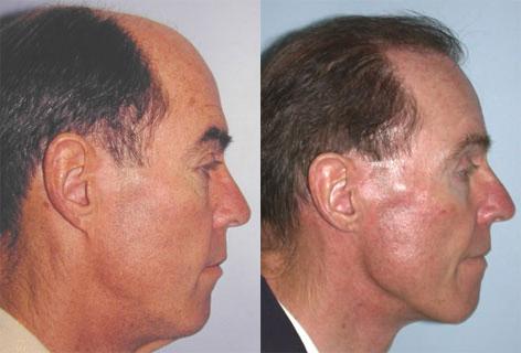 Follicular Unit Hair Grafting before and after photos in San Francisco, CA, Patient 13680
