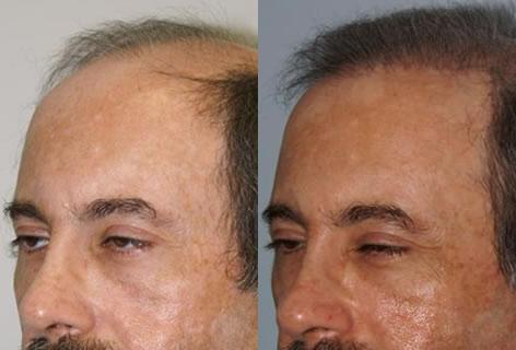 Follicular Unit Hair Grafting before and after photos in San Francisco, CA, Patient 13703