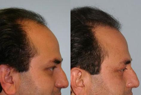 Follicular Unit Hair Grafting before and after photos in San Francisco, CA, Patient 13708