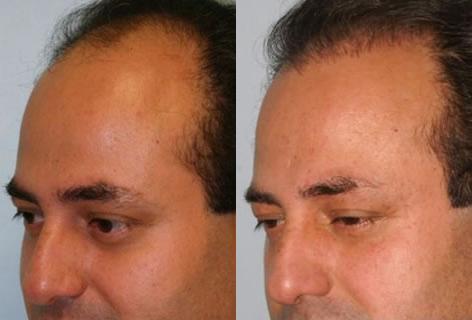 Follicular Unit Hair Grafting before and after photos in San Francisco, CA, Patient 13708