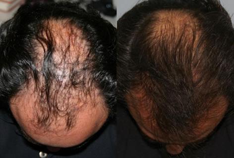 Follicular Unit Hair Grafting before and after photos in San Francisco, CA, Patient 13708