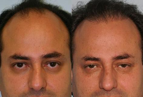 Follicular Unit Hair Grafting before and after photos in San Francisco, CA, Patient 13708