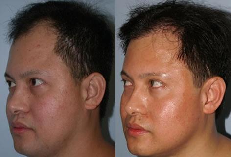 Follicular Unit Hair Grafting before and after photos in San Francisco, CA, Patient 13717