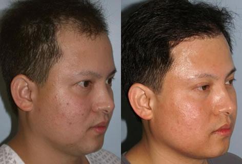 Follicular Unit Hair Grafting before and after photos in San Francisco, CA, Patient 13717