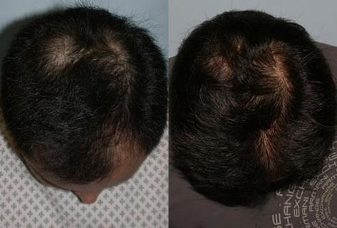 Follicular Unit Hair Grafting before and after photos in San Francisco, CA, Patient 13717