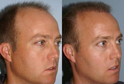 Follicular Unit Hair Grafting before and after photos in San Francisco, CA, Patient 13726