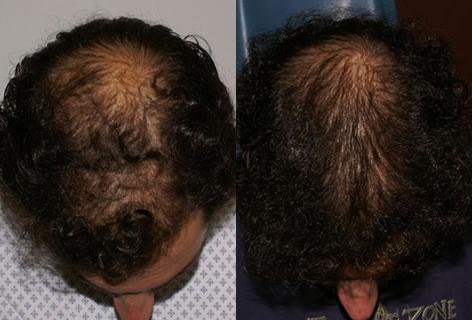 Follicular Unit Hair Grafting before and after photos in San Francisco, CA, Patient 13726