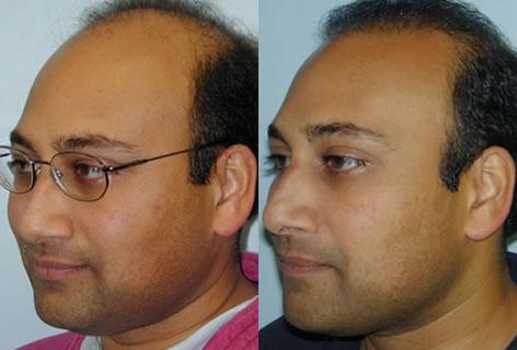 Follicular Unit Hair Grafting before and after photos in San Francisco, CA, Patient 13733