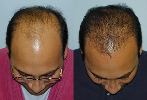 Follicular Unit Hair Grafting before and after photos in San Francisco, CA, Patient 13733