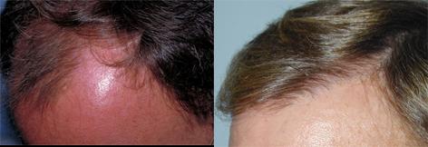 Follicular Unit Hair Grafting before and after photos in San Francisco, CA, Patient 13747