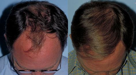 Follicular Unit Hair Grafting before and after photos in San Francisco, CA, Patient 13747