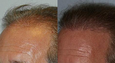 Follicular Unit Hair Grafting before and after photos in San Francisco, CA, Patient 13752