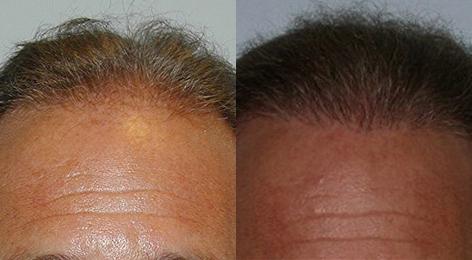 Follicular Unit Hair Grafting before and after photos in San Francisco, CA, Patient 13752