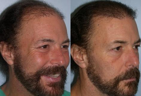 Follicular Unit Hair Grafting before and after photos in San Francisco, CA, Patient 13757